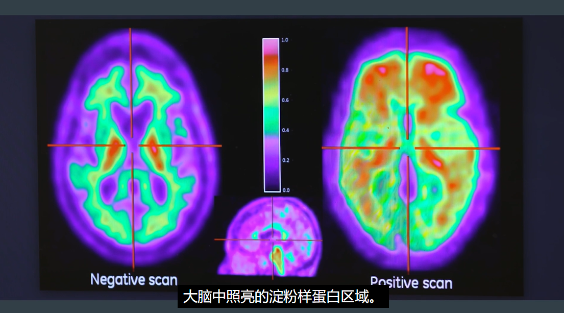 去美国看病，麦克莱恩医院阿尔茨海默患者案例及预约指南
