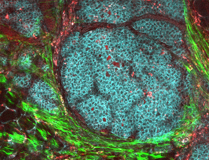 肿瘤生物学与微环境研究：了解肿瘤微环境对于诊断与治疗的重要性