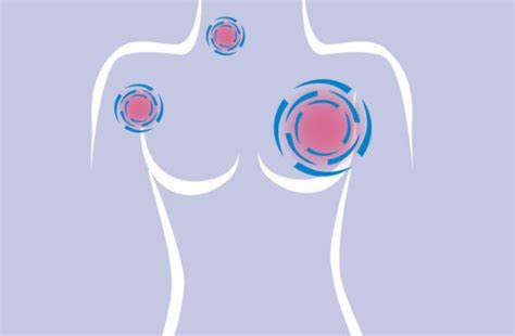 晚期乳腺癌患者实验性新激素疗法