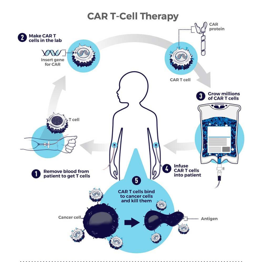 CAR-T细胞疗法在ALL、B细胞淋巴瘤和实体肿瘤中的新希望